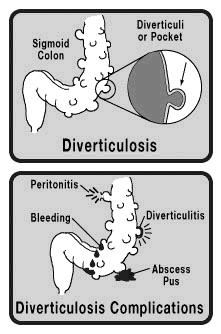 DIVERTICULOSE