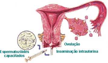 Inseminação Intra-uterina