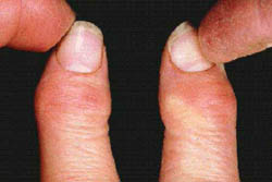 Osteoartrite das mãos