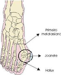 joanete