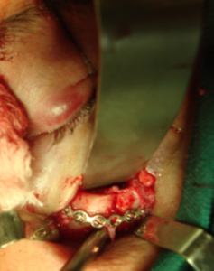 Fratura zigomática corrigida cirurgicamente