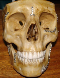 Micro placas e parafusos de titânio