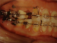 Micro placas e parafusos de titânio