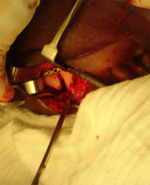 Fratura de ângulo mandibular