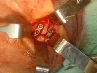 Fixação interna rígida de mandíbula