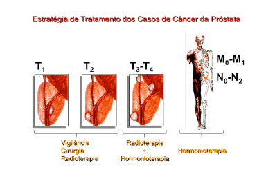 Estratégia de Tratamento do Câncer da Próstata