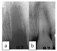 Alvéolo (Local do dente no osso) sem o dente