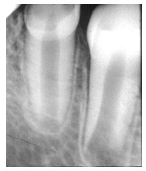 pontas das raízes abertas de dentes jovens.