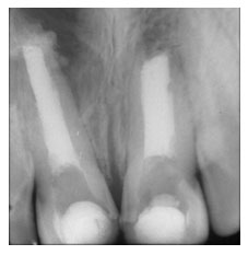 Tratamento de canal de dentes jovens.