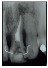 Tratamento de canal de dente adulto.